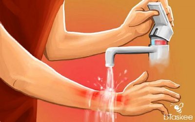 Cách chữa vết bỏng bị phồng rộp nhanh lành, không để lại sẹo