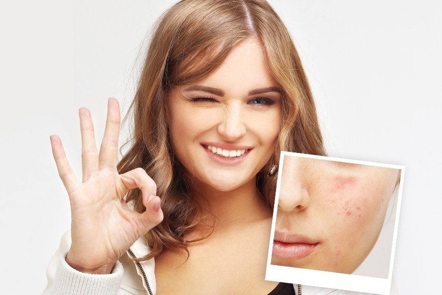 Chú ý chăm sóc, dưỡng ẩm cho da để da nhanh phục hồi sau khi nặn mụn