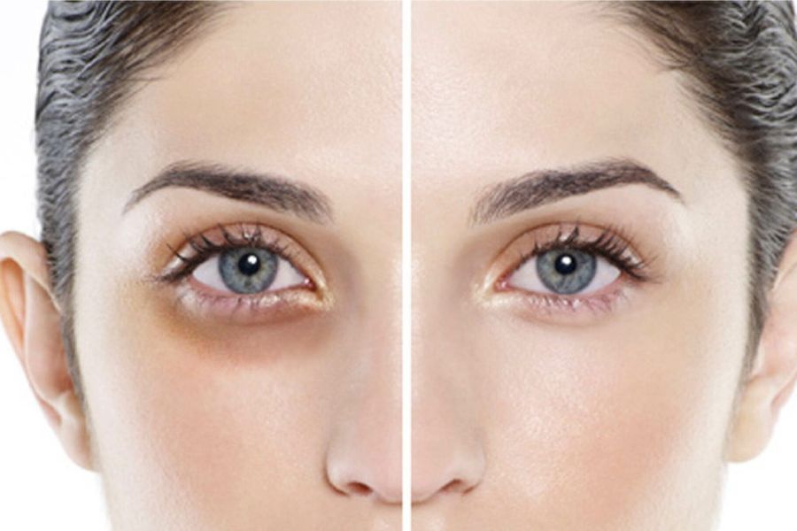 Laser là phương pháp điều trị nếp nhăn da dưới mắt