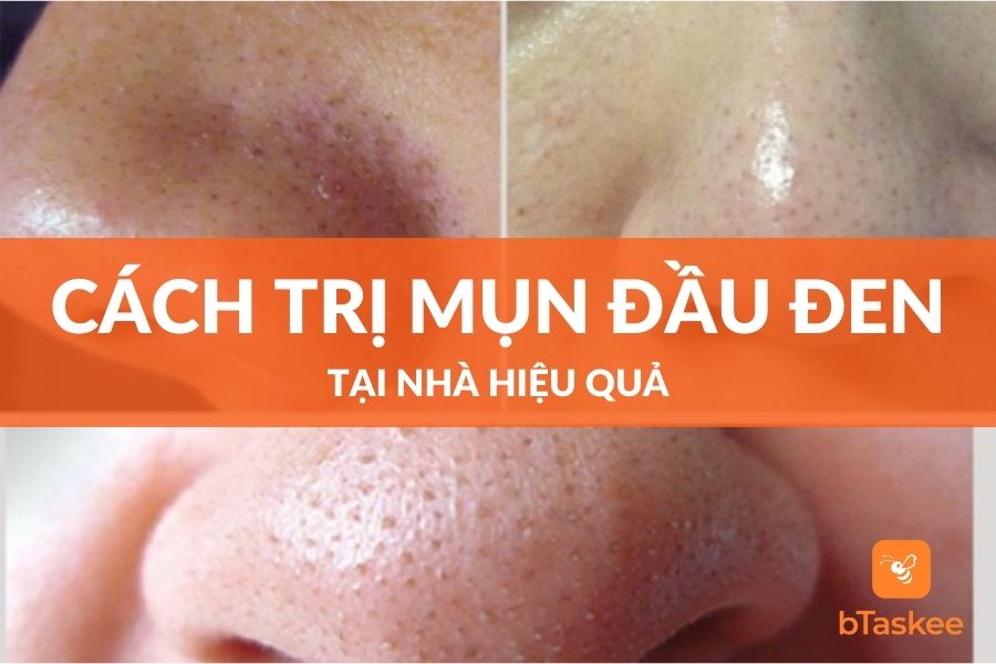 cach tri mun dau den