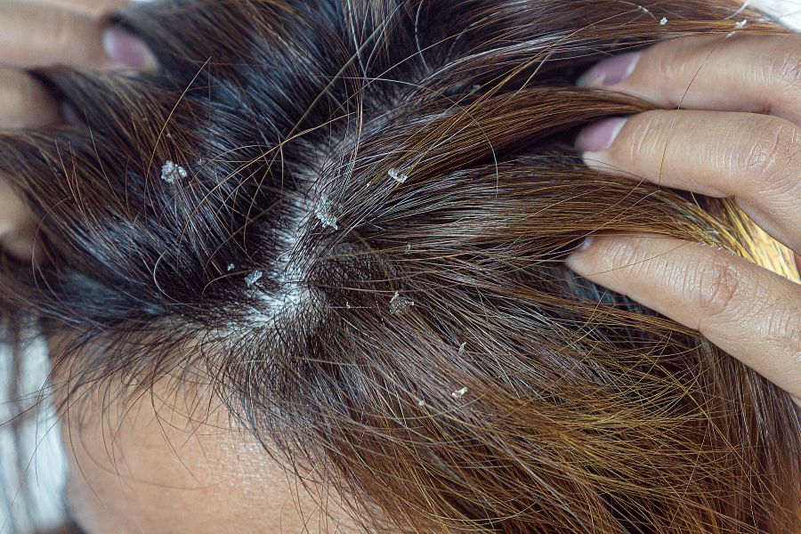 Da đầu bị khô, bong tróc thành mảng không nên tẩy tế bào chết da đầu